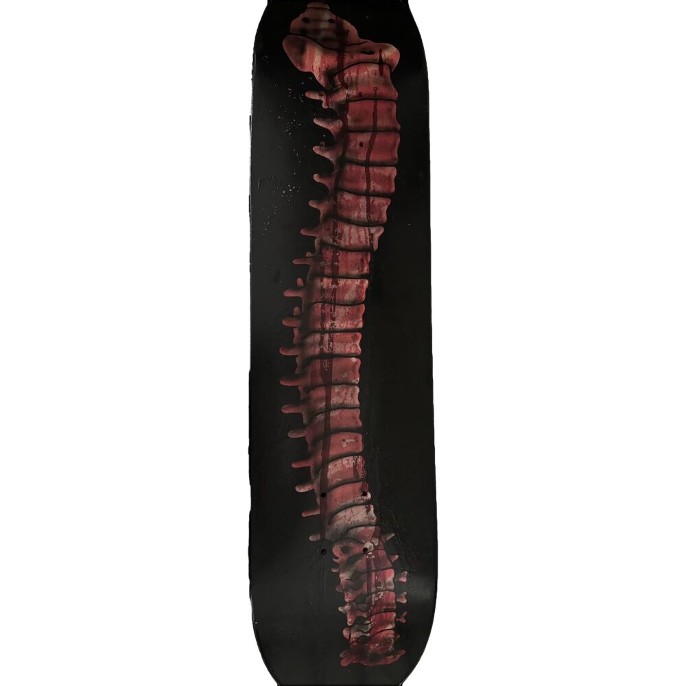 Laminectomy